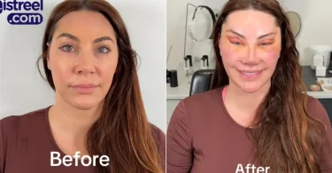 Lady’s facial transformation after six surgeries sparks mixed reactions