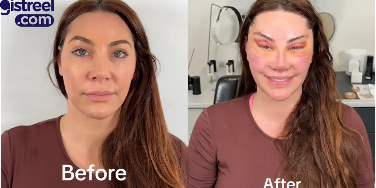 Lady’s facial transformation after six surgeries sparks mixed reactions
