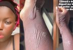 Lady wakes up with strange marks on hand after dreaming she dipped it in hot water