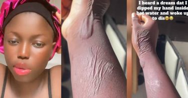 Lady wakes up with strange marks on hand after dreaming she dipped it in hot water