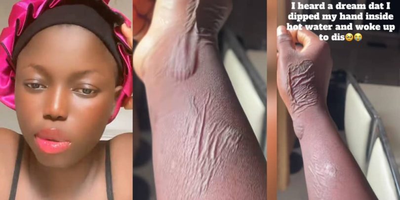 Lady wakes up with strange marks on hand after dreaming she dipped it in hot water