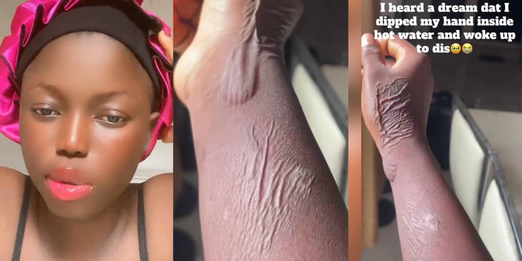 Lady wakes up with strange marks on hand after dreaming she dipped it in hot water
