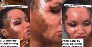 Lady uses special chemical to bleach her skin, flaunts results