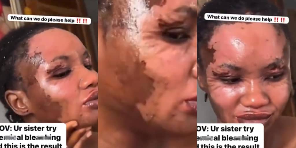 Lady uses special chemical to bleach her skin, flaunts results
