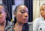 Lady accuses aesthetic clinic of permanent scar following skincare treatment