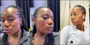 Lady accuses aesthetic clinic of permanent scar following skincare treatment
