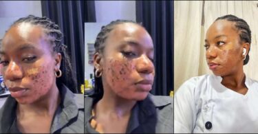 Lady accuses aesthetic clinic of permanent scar following skincare treatment