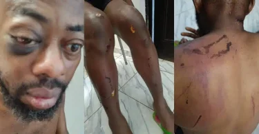 Photos show injuries sustained by NANS president after alleged attack by Seyi Tinubu’s thugs