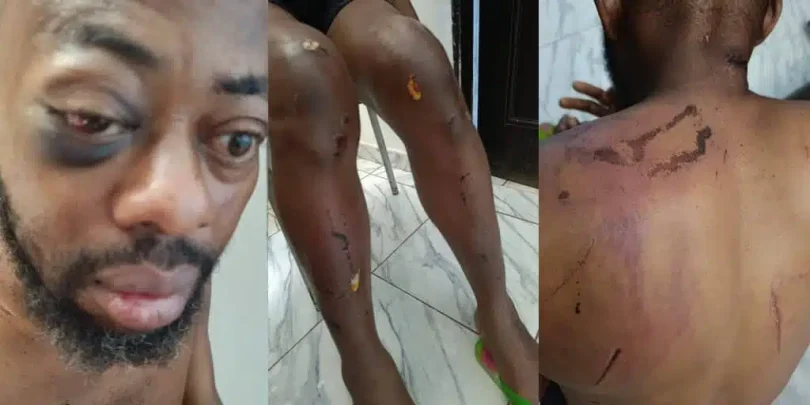 Photos show injuries sustained by NANS president after alleged attack by Seyi Tinubu’s thugs