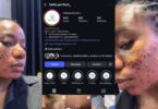 Clinic allegedly vows to jail lady for speaking out after acne treatment results in permanent scar