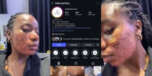 Clinic allegedly vows to jail lady for speaking out after acne treatment results in permanent scar
