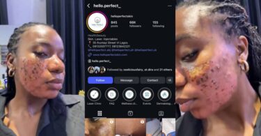 Clinic allegedly vows to jail lady for speaking out after acne treatment results in permanent scar